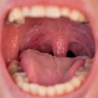 Dentist warning as dry mouth could be 'red flag' symptom of 5 serious illnesses