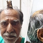 Man's horror as four-inch 'devil horn' grows out of his head