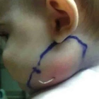 Mother screamed when she saw the Iump on baby’s neck, doctors were shocked when they discovered the cause!