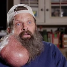 Man finally overcomes ‘obstacle’ that was stopping his ‘watermelon-sized’ facial tumour being removed