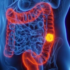 Four colon cancer symptoms that are ‘often dismissed’, as revealed by a doctor