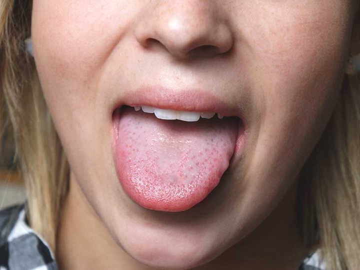 how-to-stop-tongue-pain-after-eating-pineapple-enc-today