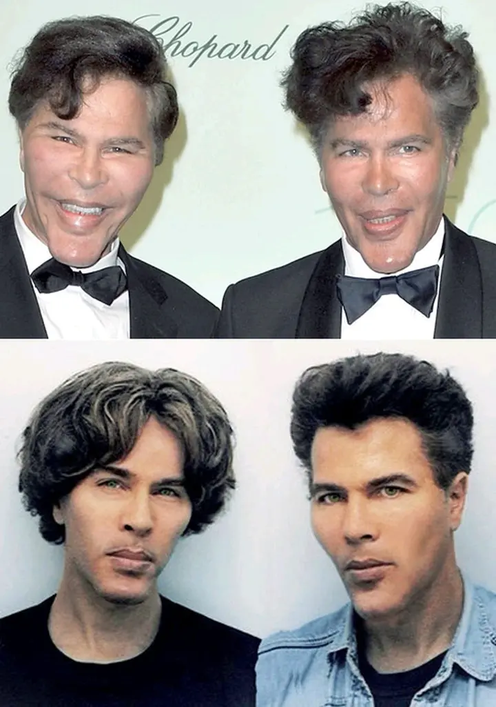 These Twin Brothers Changed Their Faces With Plastic Surgery, They Looked Before (See Photos)