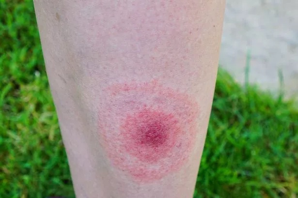 A circular or oval shape rash around a tick bite can be a symptom