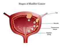Carcinoma of the bladder 