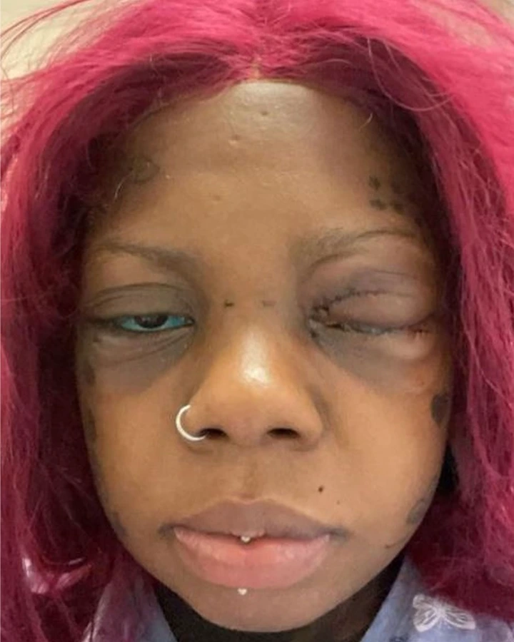Peterson with swollen eye