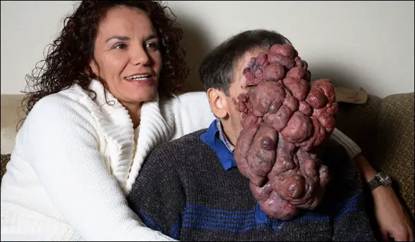 Facial-Tumor-Man-With-No-Face