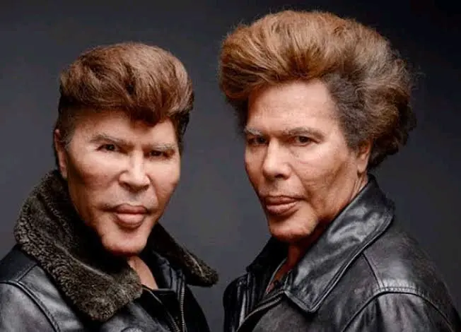These Twin Brothers Changed Their Faces With Plastic Surgery, They Looked Before (See Photos)