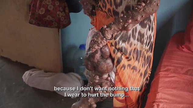 The 42-year-old has to wear loose clothing in order to fit them over her large tumors