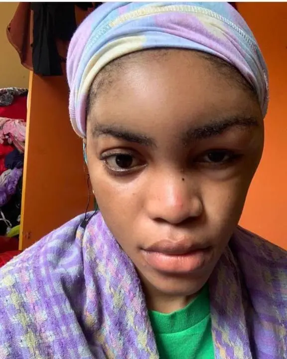 Camille's brother shared the photos of her badly bruised face on social media [KemiFilani]