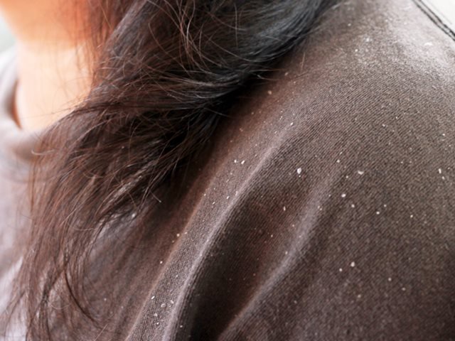 Dandruff treatment at home, Homemade anti dandruff hair mask, DIY anti dandruff hair pack, Home remedies to cure dandruff, DIY remedies to prevent dandruff