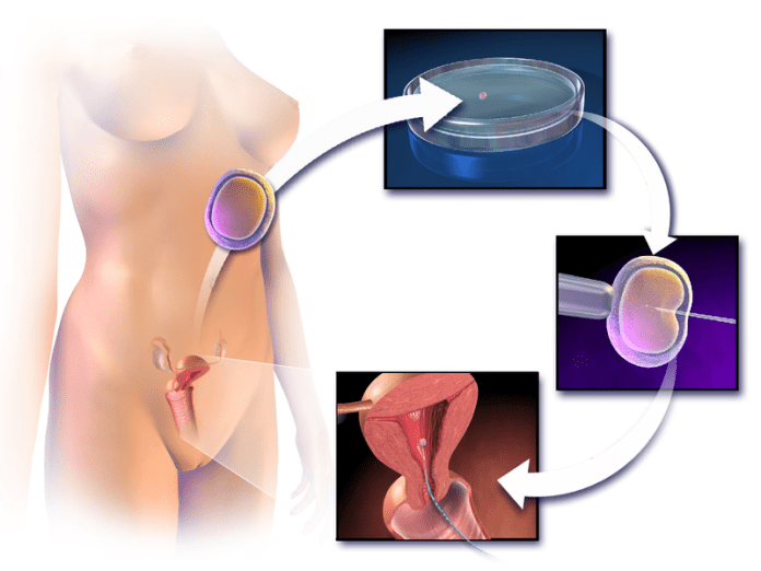  Cost of IVF in Nigeria