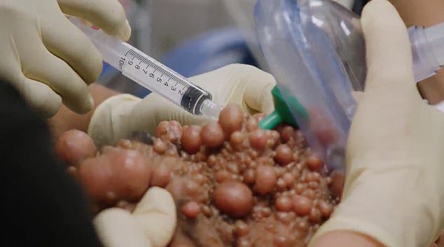 Preparing for surgery, the medical team couldn't find a vein to infuse anesthesia through because of all the tumors.