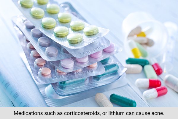 risk factors that can dispose you to acne