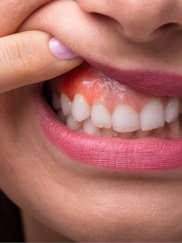 Gum diseases