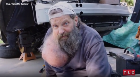 Take My Tumor, TIm