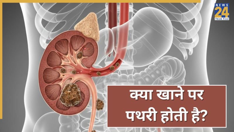 Kidney Stones