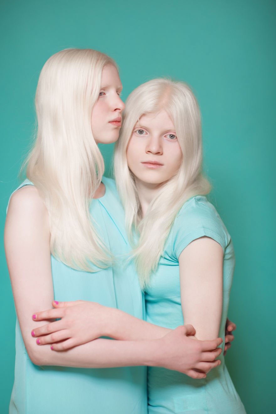 Pure Beauty Of Albino Kids