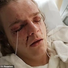 Disabled boy, 18, faces permanent blindness 'after bully, 17, hurdled powdered drain cleaner into his eyes,' turning his skin black and leaving him unable to see