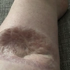 Mum who saw doctors 30 times reassured her rash was 'just flaky skin' before being left with huge crater in leg
