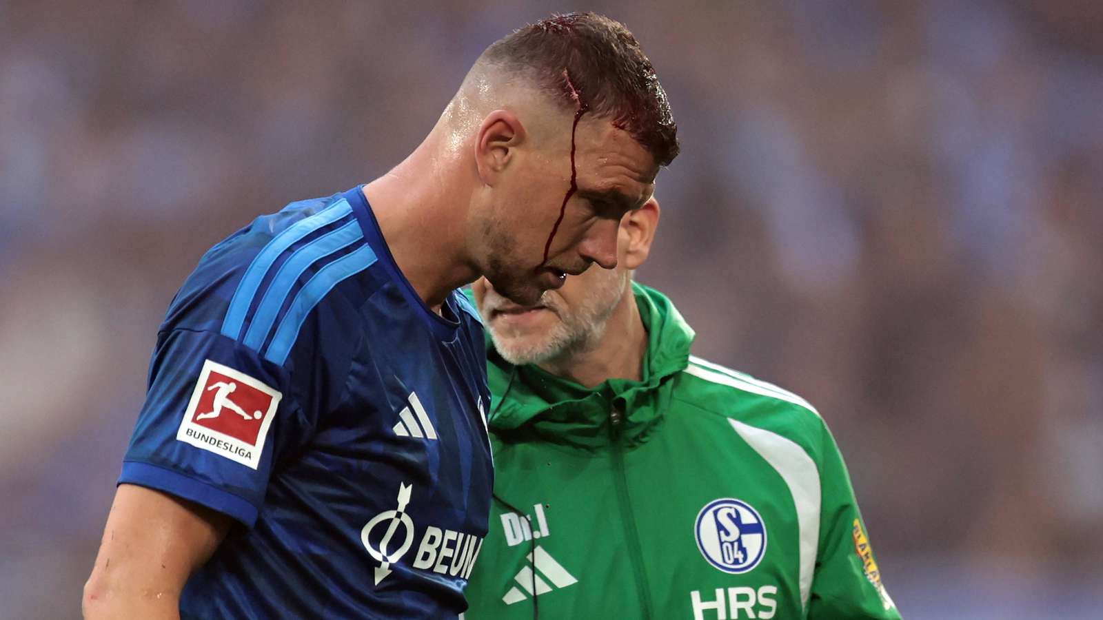 Edin Dzeko beim Schalke-Spiel gegen Mainz mit einer blutenden Wunde am Kopf.