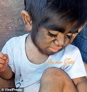 Medics have told Alma that laser hair removal could be an option for the boy