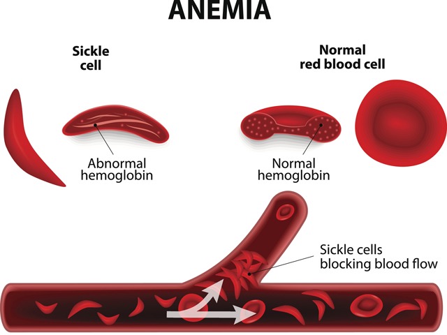sickle cell disease: Swelling of hands &amp; feet, fatigue, irritability:  Everything you need to know about sickle cell disease - <a class=