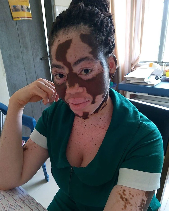 More Photos of How The Black Skin of a Nurse Got Wiped off Completely