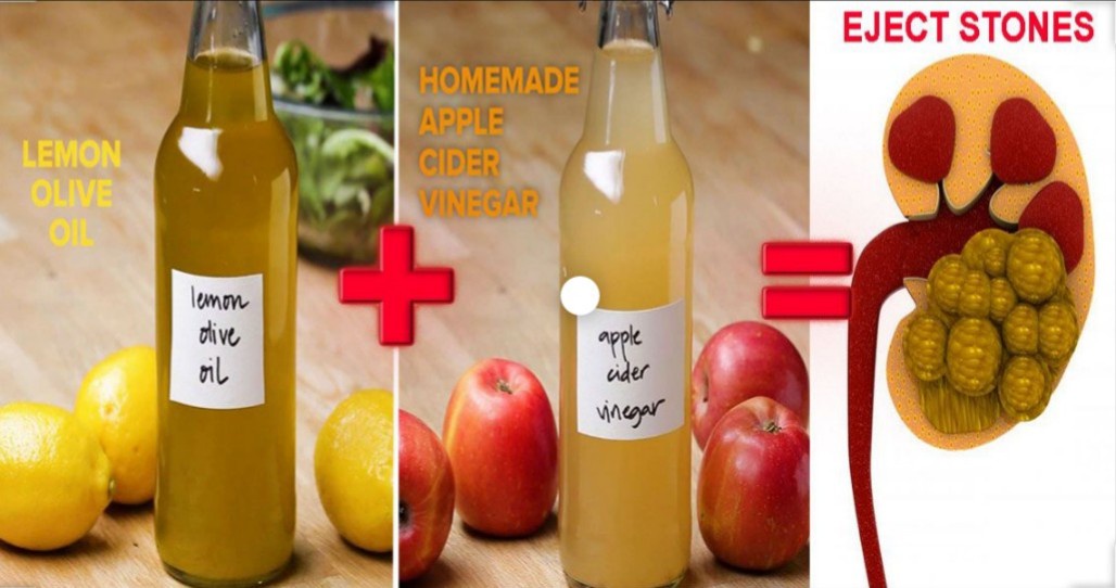is apple juice good for kidney stones