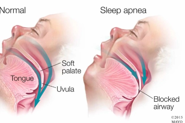 Five Common Reasons Why People Die While Sleeping. 3 417aa6c5e9dd42a4b6e9fe45633d540d?quality=uhq&resize=720