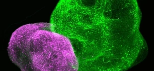 Scientists restore brain cells impaired by a rare genetic disorder