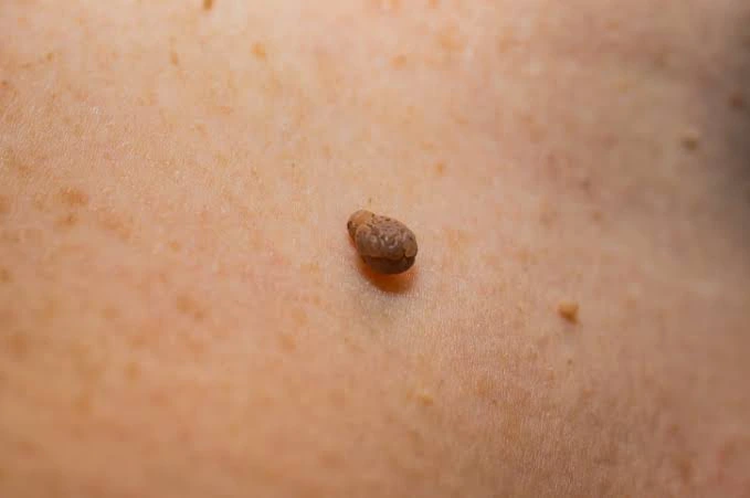 Causes Of Skin Tags And Ways To Treat It  43fb318a58f64eaeacb824e58de880fe?quality=uhq&format=webp&resize=720