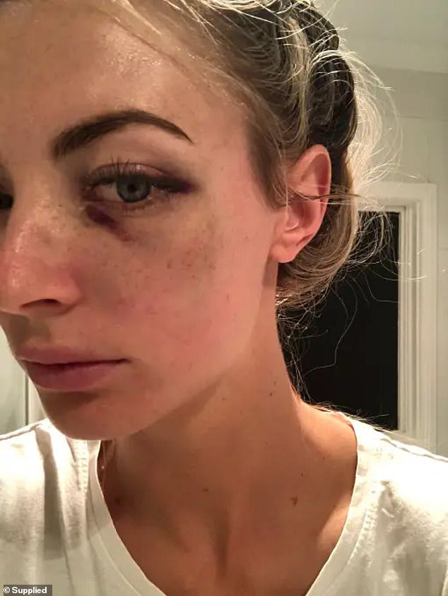 Raychel Lewis was hospitalised after being headbutted and hitting her head on the ground