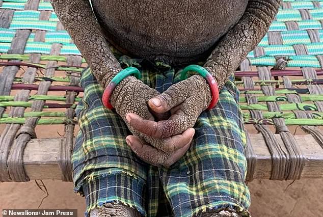 The condition also heavily affects her arms, hands and stomach and makes it painful for her to sit, walk or travel to medical appointments