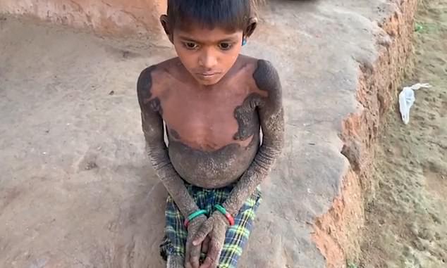 Ichthyosis is not usually life-threatening, but there is no cure and patients are likely to show the symptoms for life