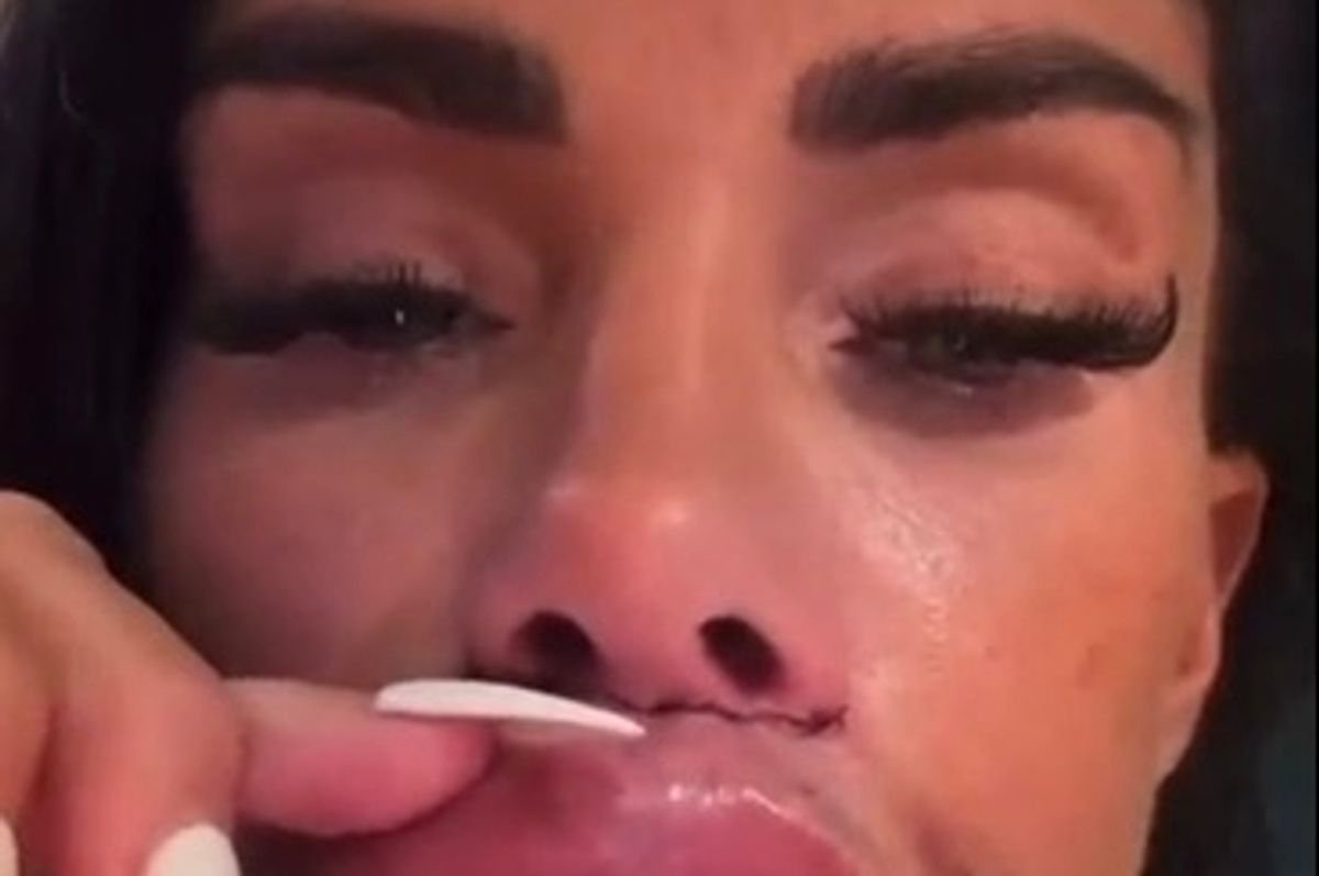 Katie Price shows off harsh reality of lip lift surgery