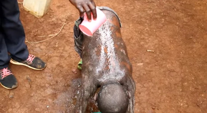 L'histoire d'un garçon de 12 ans né avec une peau très chaude et dure comme une pierre-VIDEO