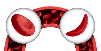 How might sickle cell disease impact sexual function? | ISSM