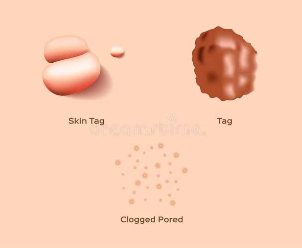 Causes Of Skin Tags And Ways To Treat It  4ae2676c8d81466bb24ddc8895b4529a?quality=uhq&format=webp&resize=720