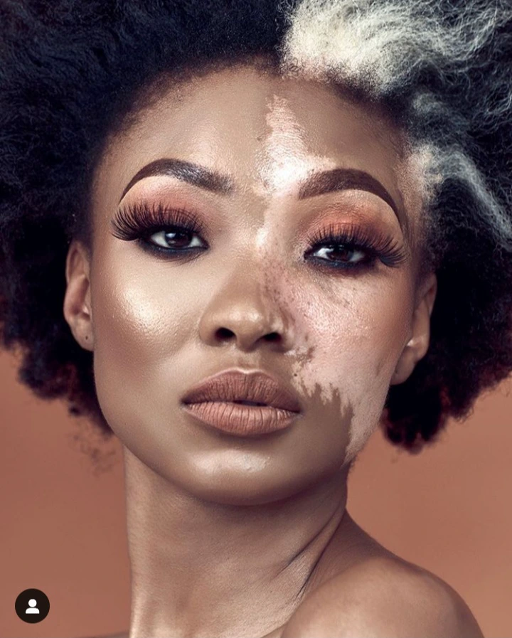 Top 5 Mzansi Celebrities Living with Vitiligo.