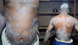 Man gets skin disease