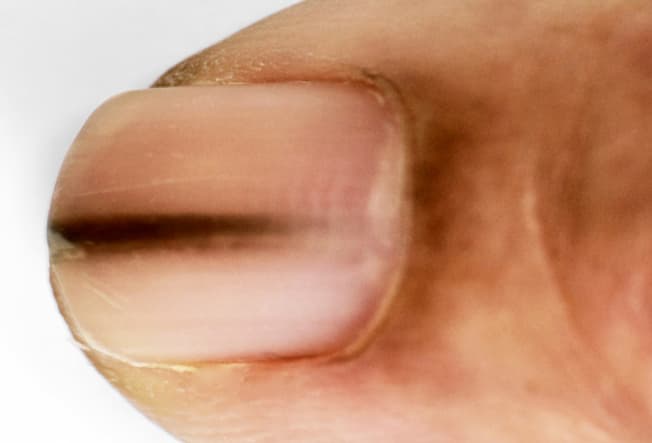 Dark Lines Beneath the Nail