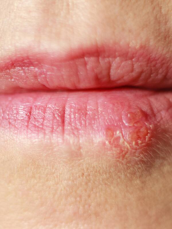 Herpes
