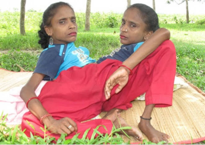 Meet The Conjoined Twins Who Fell In Love With The Same