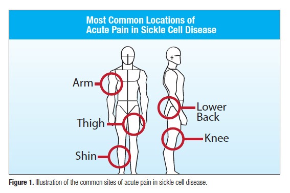 Pain Management Dilemmas of Sickle Cell Disease