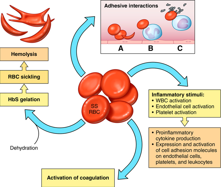 Figure 1 from SICKLE CELL DISEASE : CHALLENGES AND PROGRESS Beyond hydroxyurea : new and old drugs in the pipeline for sickle cell disease | Semantic Scholar