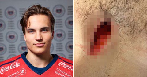 Side by side photos of Jonas Nyhus Myhre with his chest wound.