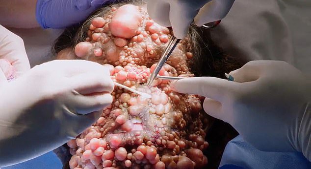 Ms Sahadeo underwent 60 hours of surgery in total and the doctor was able to remove hundreds of tumors