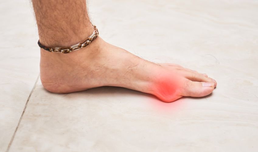 BUNION