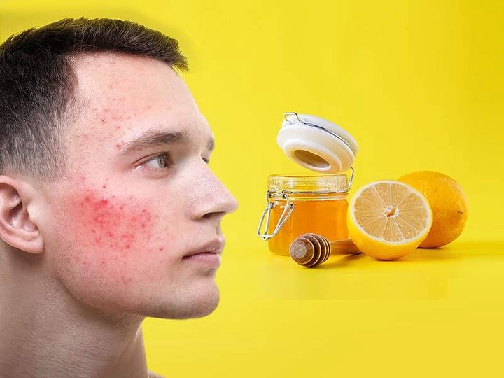 Acne on face: Amazing honey and lemon mixture to get rid of pimples from face - lifealth